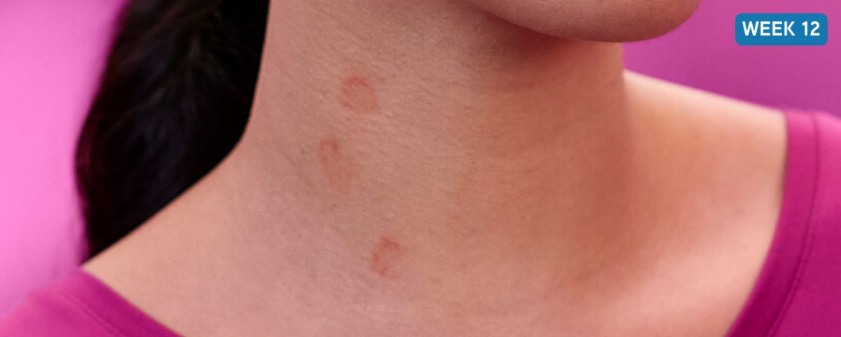 Photo of the neck of a CSU patient with a light complexion and a decrease in the number of hives visible. Text reads: After XOLAIR