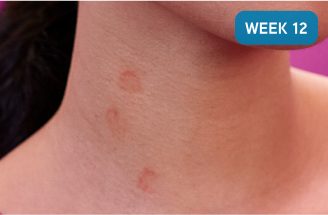 Photo of the neck of a CSU patient with a light complexion and a decrease in the number of hives visible. Text reads: After XOLAIR