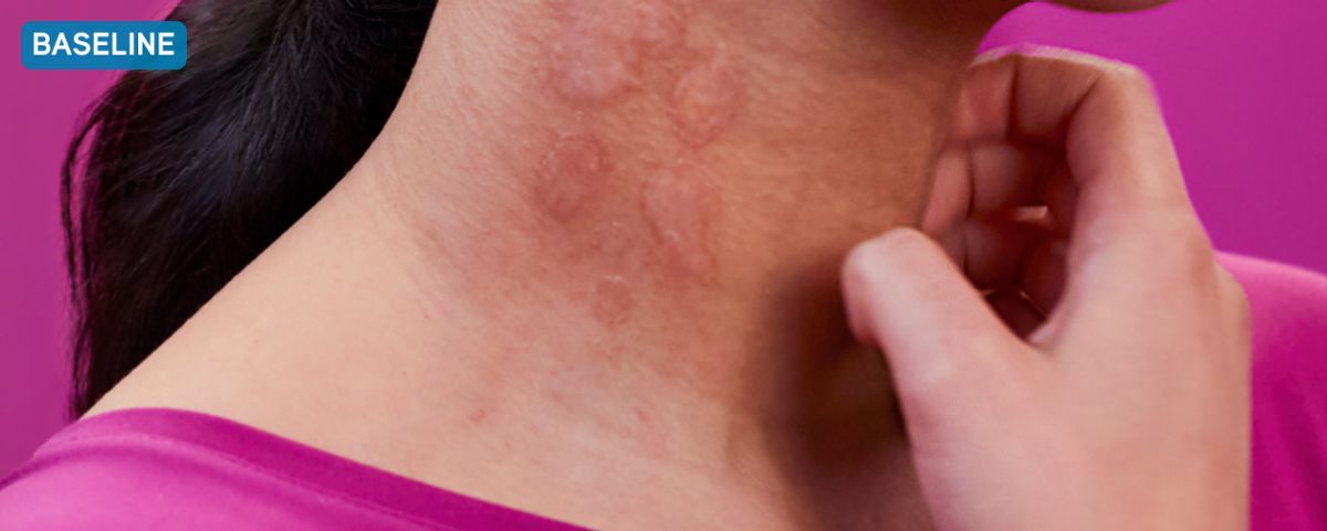 Photo of the neck of a CSU patient with a light complexion and several hives visible. Text reads: Before XOLAIR