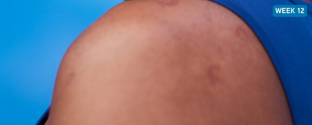 Photo of the shoulder of a CSU patient with a dark complexion and a decrease in the number of hives visible. Text reads: After XOLAIR