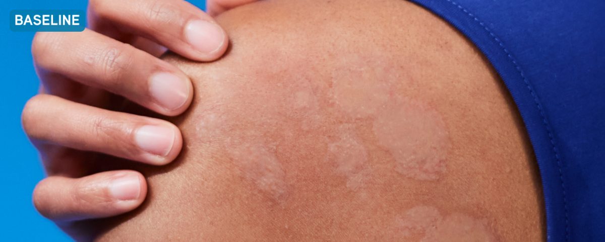 Photo of the shoulder of a CSU patient with a dark complexion several hives visible. Text reads: Before XOLAIR